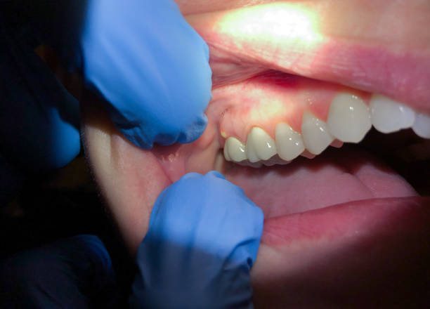 Best Broken or Cracked Tooth Emergency Dentist in Churchville, NY