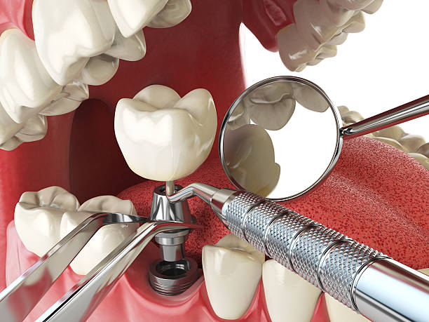 Best Emergency Dentist for Knocked-Out Tooth in Churchville, NY